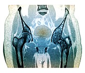 Hips in Paget's disease,CT scan