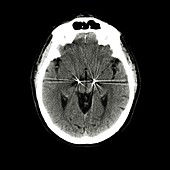 Parkinson's brain pacemaker,CT scan