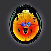 Parkinson's brain pacemaker,CT scan