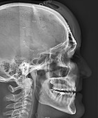 Fixed skull fractures after road accident
