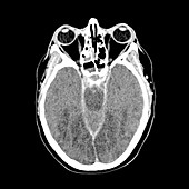 Brain death following cardiac arrest,CT