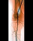 Peripheral vascular disease in diabetes