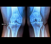 Varus deformity in osteoarthritis,X-ray