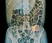 Gastric pacemaker in gastroparesis,X-ray