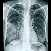 Lungs in pneumonia,X-ray
