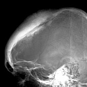 Brain tumour,X-ray