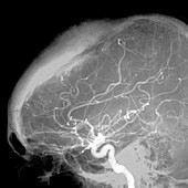 Brain tumour blood supply,X-ray