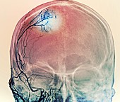 Brain tumour blood supply,X-ray and CT