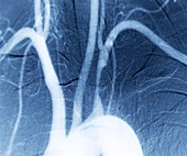 Narrowed artery,X-ray