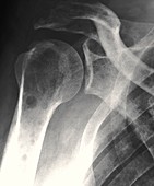 Secondary bone cancer,X-ray