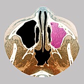 Sinus infection,CT scan