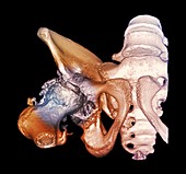 Osteoarthritis of the hip,3D CT scan