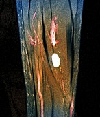 Schwannoma nerve sheath tumour,MRI