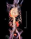 Arterial dissection,3D CT scan