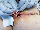 Draining pus from infected surgical wound