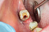 Root canal pulp extraction from molar