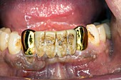 Dental gold-plastic bridge