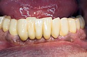 Dental metal-ceramic bridge