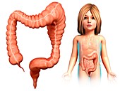 Child with mega colon,illustration