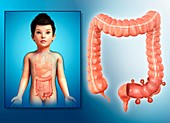 Diverticulosis in a child,illustration