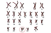 Down's syndrome karyotype,illustration