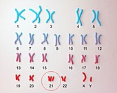 Down's syndrome karyotype,illustration