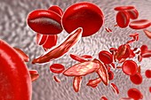 Sickle cell anaemia,illustration