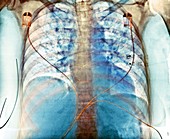 Aspiration,chest X-ray
