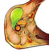 Lipoma of the shoulder,X-ray