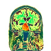 Pituitary tumour,CT scan