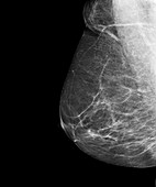 Breast cancer screening,X-ray