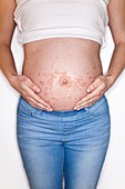 Pregnant woman with rash on tummy