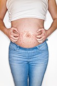 Pregnant woman scratching rash on tummy
