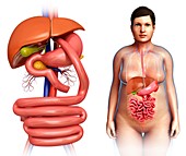 Gastric bypass,illustration