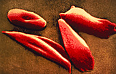 False-col SEM of red cells in sickle cell disease