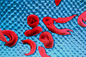 False-colour SEM of sickle cell anaemia blood