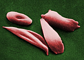 Sickled red blood cells