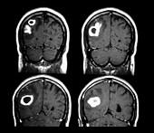MRI of Staphylococcus Abscess