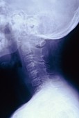 X-ray of a neck affected by rheumathoid arthritis