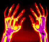 Col X-ray of hands with rheumatoid arthritis