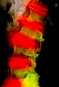 Osteoarthritic spine,X-ray