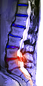 Arthritic Spine