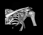 3D CT of the Shoulder