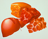 Artwork of the stages of liver cirrhosis
