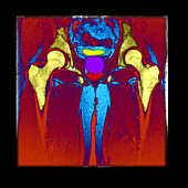 CT scan of a normal male pelvis