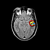 Temporal Lobe Cavernous Malformations