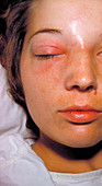 Woman With Staphylococcal Infection
