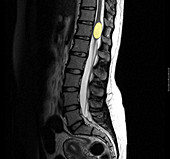 Benign Cyst in the Spine
