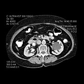 CT of Large Parapelvic Renal Cyst