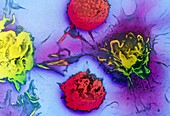 F/col SEM of cancer cells and lymphocytes